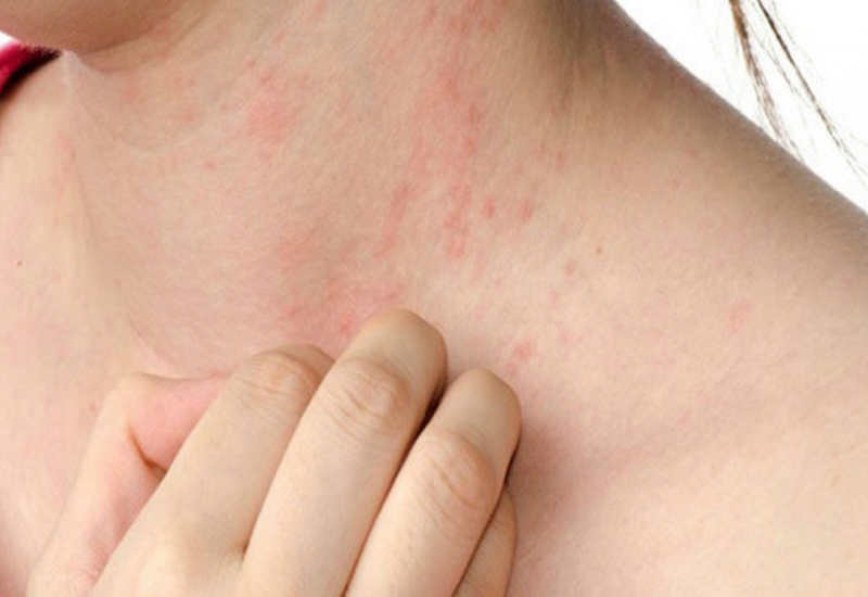 Nguyên nhân gây ra nổi sảy