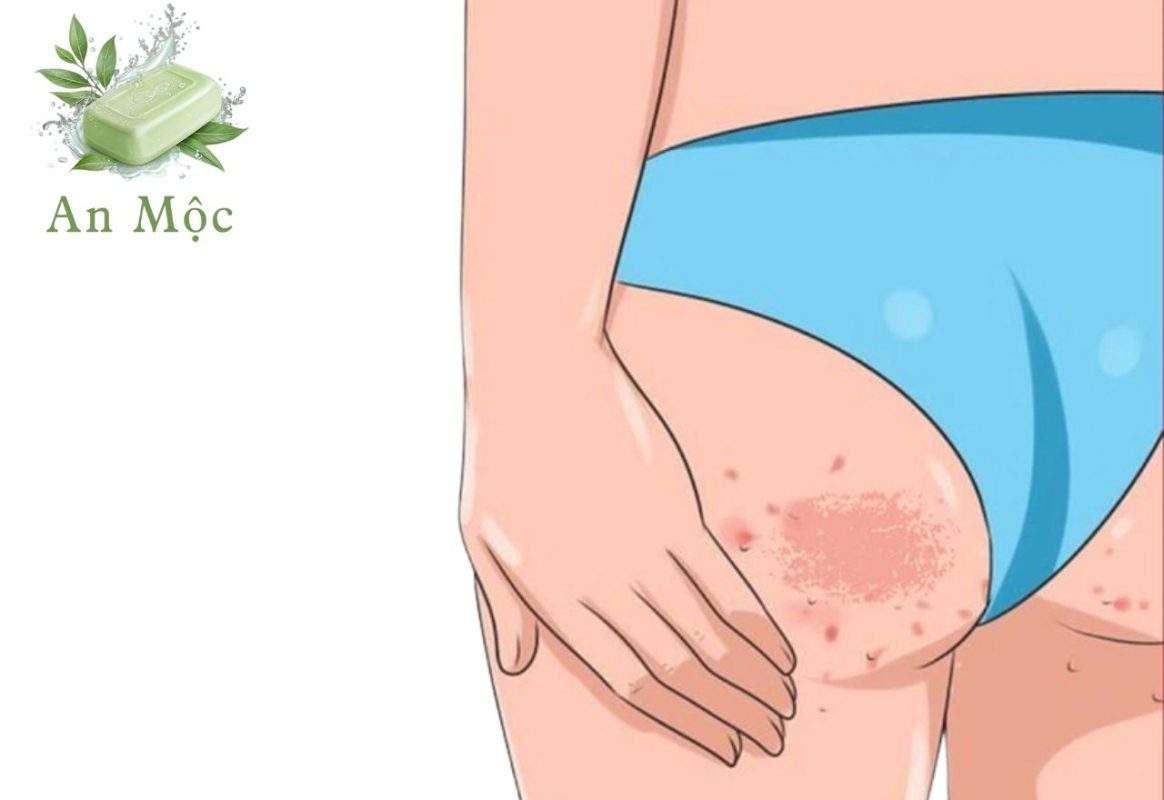 Bí Quyết Trị Chai Sần Vùng Mông Bằng Xà Bông An Mộc 